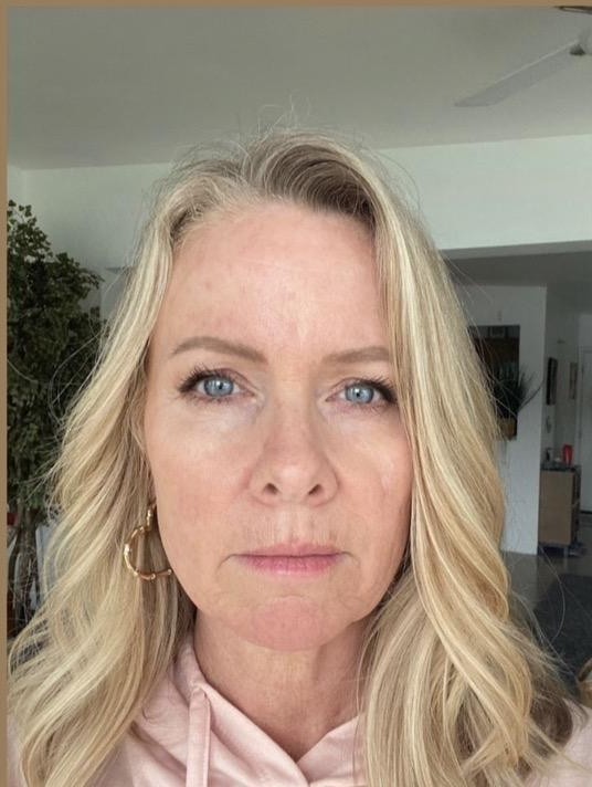 Micro-needling with Stem Cells — after