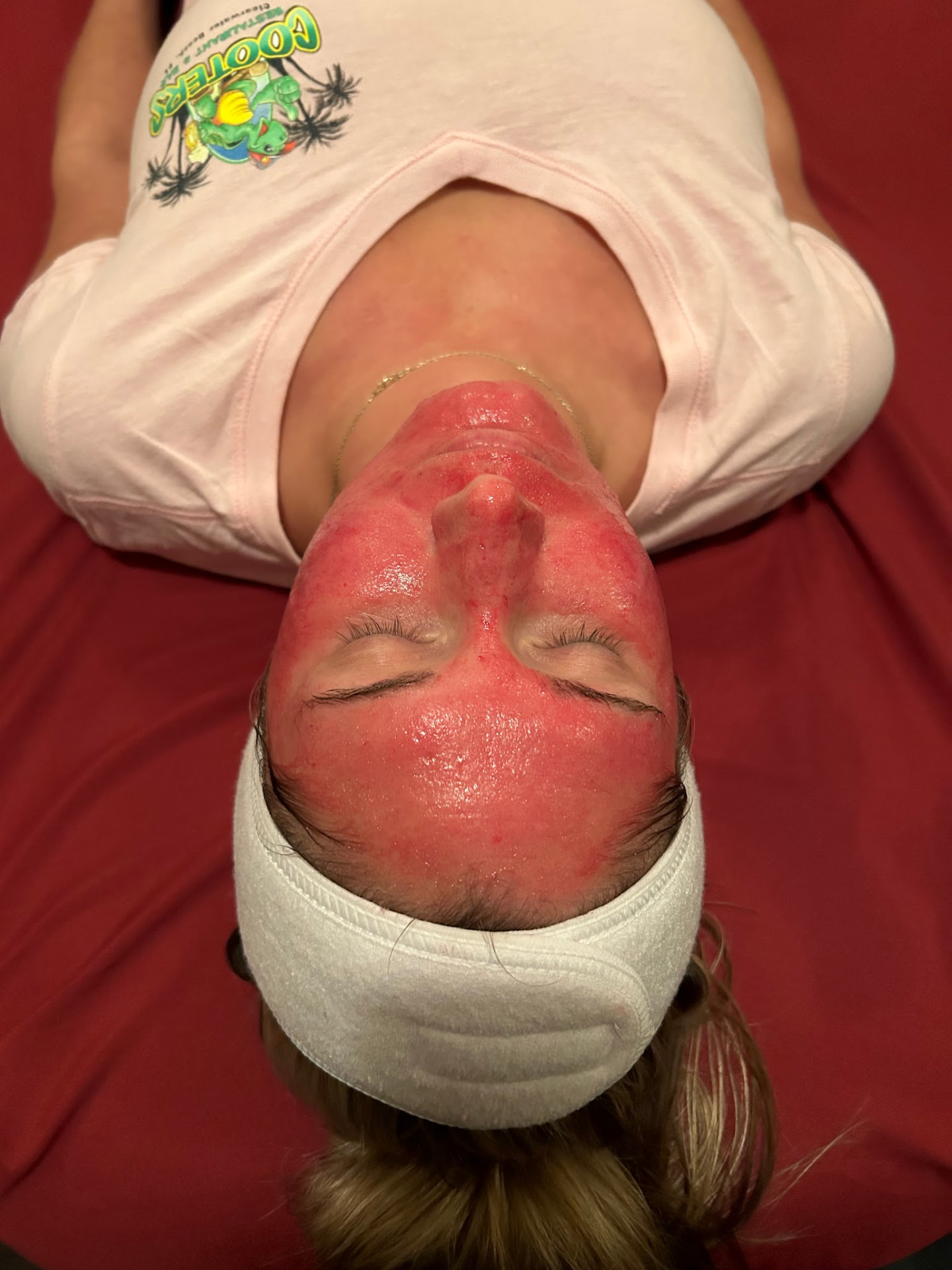 Micro-Needling with Chemical Peel — before