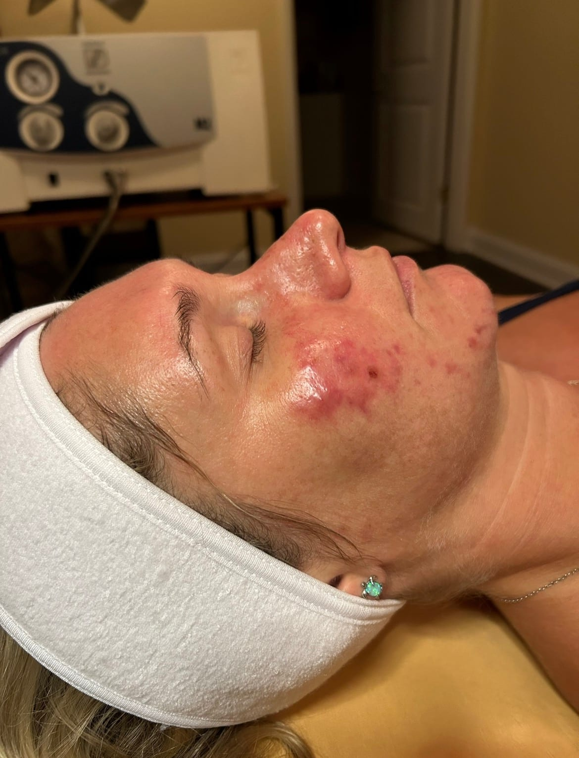Chemical Peel — before