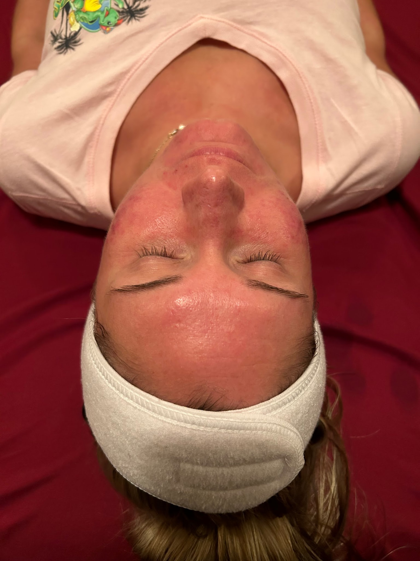 Micro-Needling with Chemical Peel — after