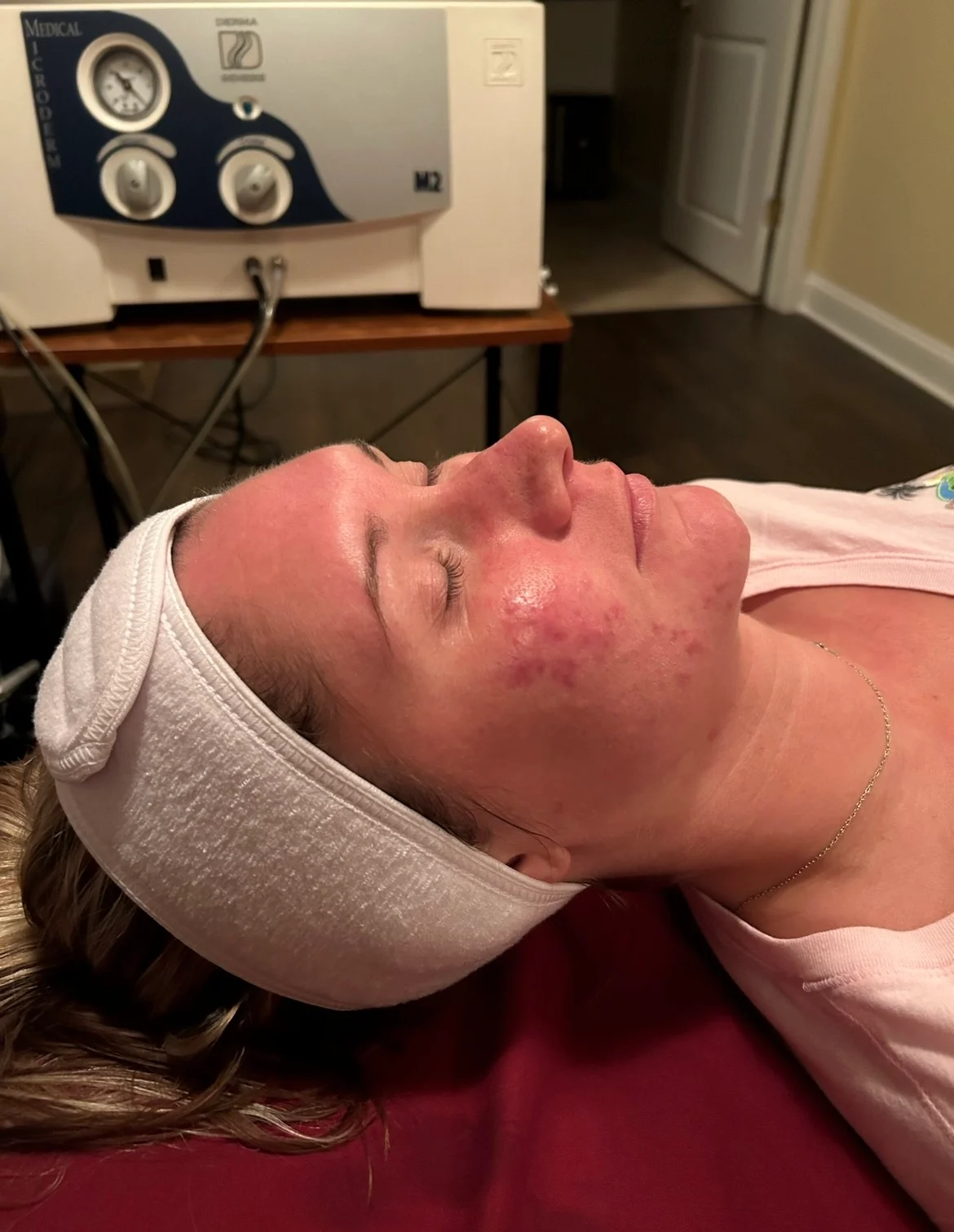 Chemical Peel — after