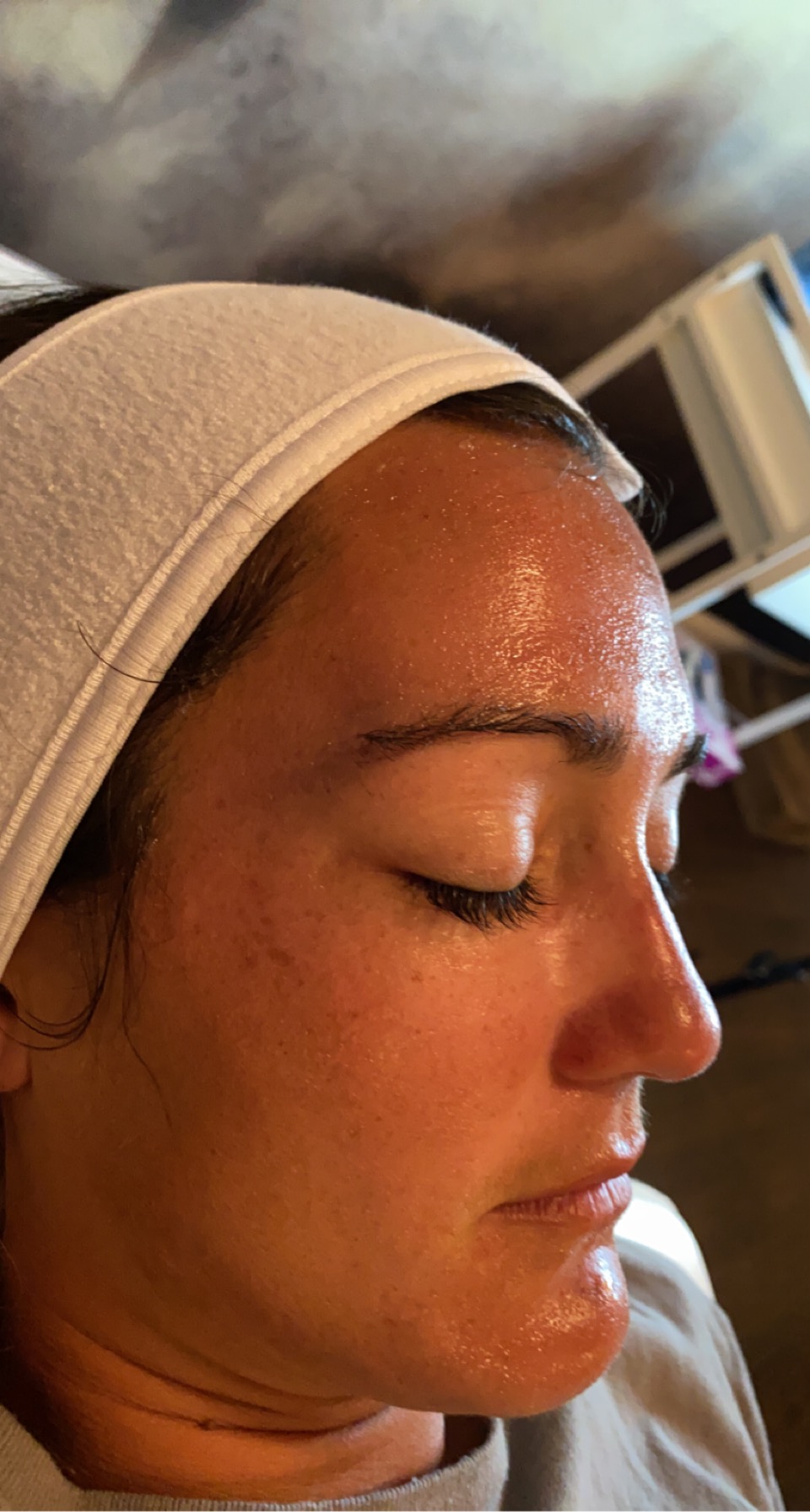 Cryo Facial — after