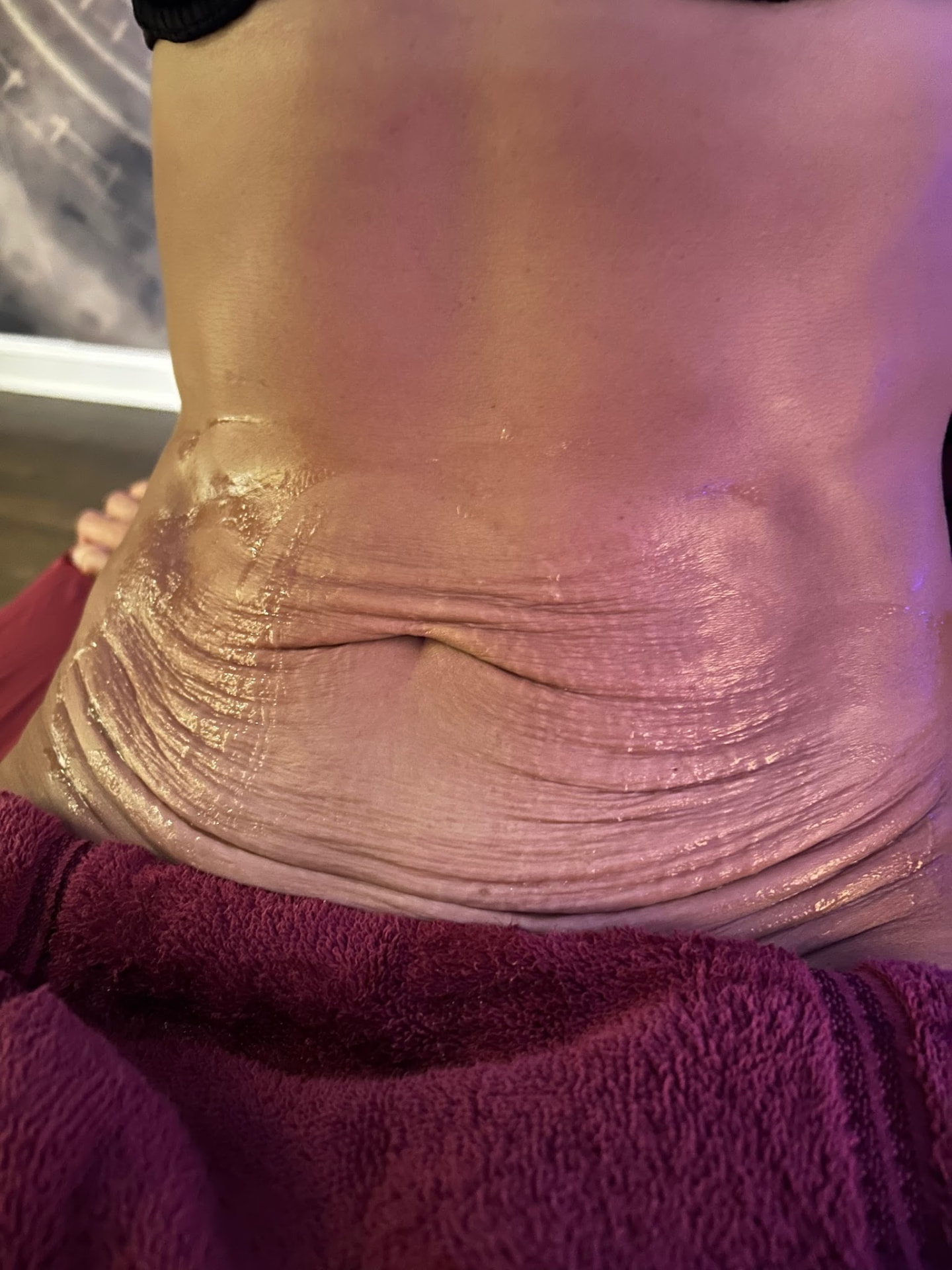 Cryo Slimming — before