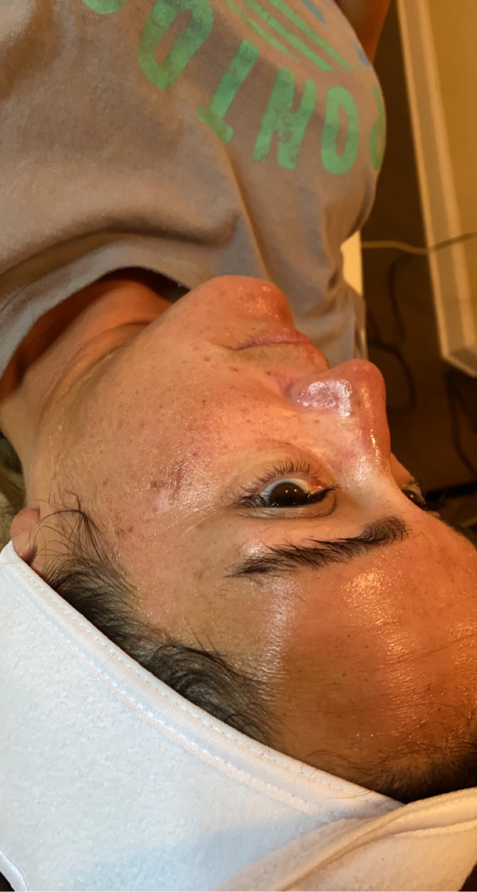 Cryo Facial — before