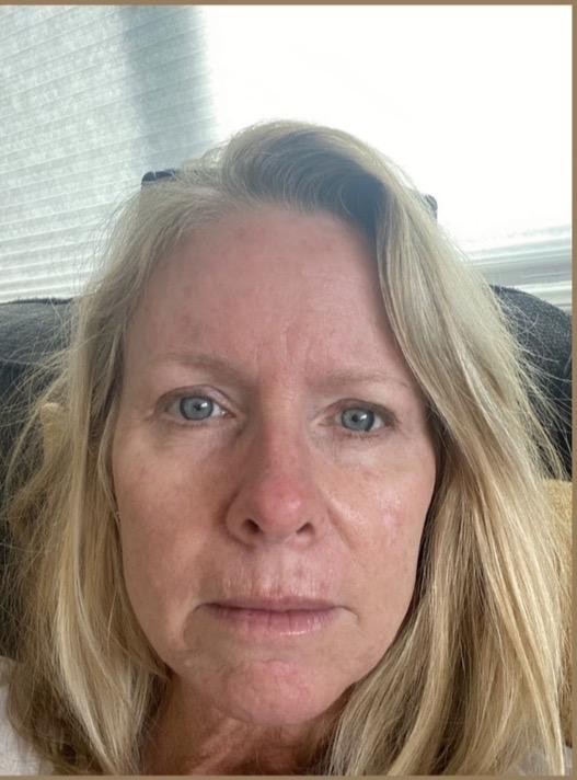 Micro-needling with Stem Cells — before