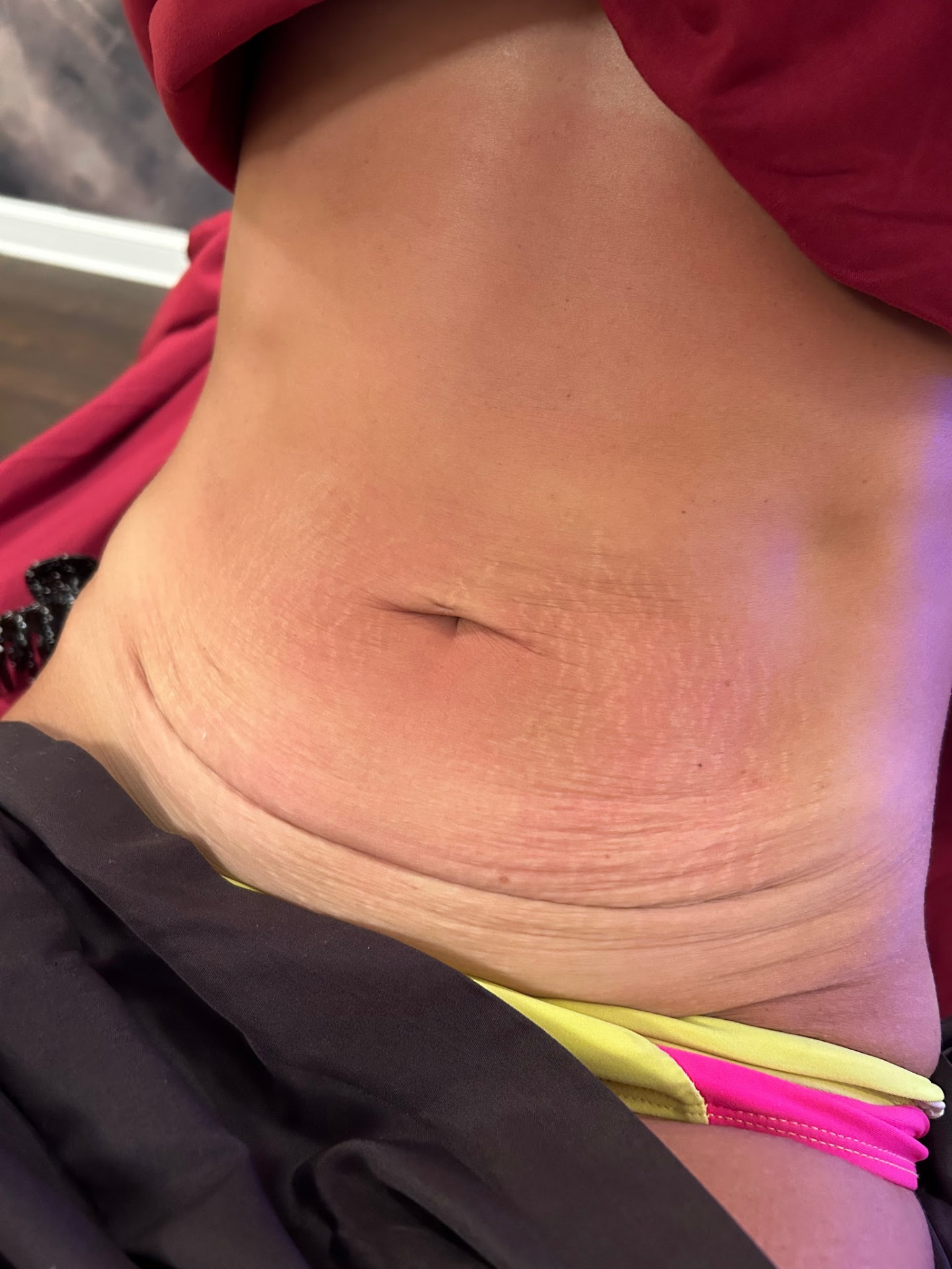 Cryo Slimming — after